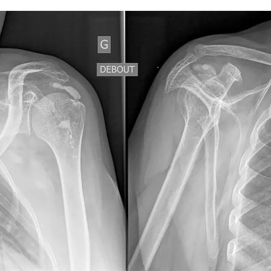 x-ray right shoulder ap and axial
